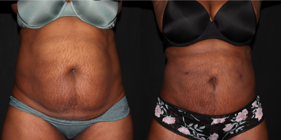 45-54 year old woman treated with Skin Tightening - Liposuction to abdomen and flanks with Renuvion skin tightening to abdomen.