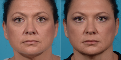 45-54 year old woman treated with Radiesse - Liquid Facelift with RadiesseBotox to forehead