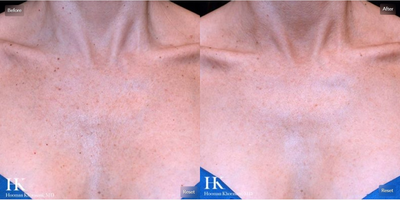Woman treated with ActiveFX - Woman treated with ActiveFX