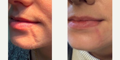 Woman treated with MiXto Laser, CO2 Laser, Scar Removal - Scar removal with Mixto Co2 Laser subcision fillers
