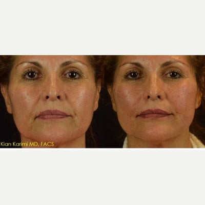 Lifting of Cheeks and Lower Third of Face with NovaThreads - Demonstrating immediate results with NovaThreads, the newest dissolvable polydiaxanone (PDO) threads used for in office lifting and tightening of the face. Threads are placed under local anesthetic in the office and have minimal to no downtime. Results are expected to last between 6-12 months depending on how many threads are placed and how heavy the tissues are. Although this is not a suitable replacement for someone who needs a facelift, it can give excellent temporary lifting results in patients who are not ready for surgery.
