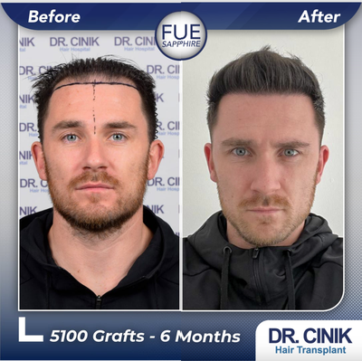 35-44 year old man treated with FUE Hair Transplant - 5100 grafts