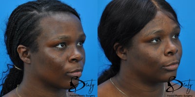 21-30 year old woman treated with Alarplasty, Brow Lift, Facial Fat Transfer - 21-30 year old woman treated with Alarplasty, Brow Lift, Facial Fat Transfer