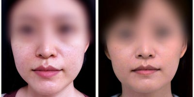 25-34 year old woman treated with Botox for TMJ - Check out these amazing results from botox for masseters.