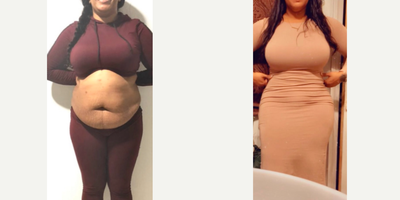 35-44 year old woman treated with Tummy Tuck, Liposuction, Brazilian Butt Lift - Excellent outcome after full body intense liposuction including abdomen, waist, laterals, upper and lower back plus DOMINICAN BUTT LIFT by Mallol getting better volume, contour and butt projection.