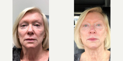Woman treated with Dermal Fillers - Woman treated with Dermal Fillers using Restylane to nasolabial folds as well as RHA 4 fillers to cheek area for a more youthful and rejuvenated look