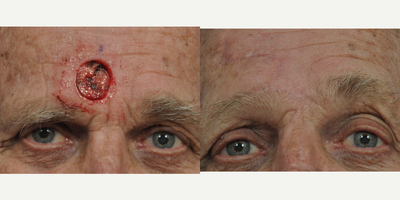 65-74 year old man treated with MOHS - Mohs surgery is a precise surgical technique used to treat skin cancer.