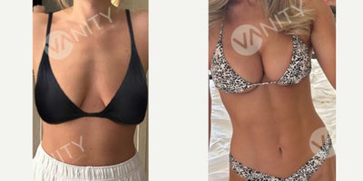 25-34 year old woman treated with Breast Augmentation, Breast Lift, Breast Implants - Breast augmentation performed to enhance volume and improve proportion. Implants were placed to achieve a fuller yet natural contour.
