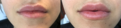 25-34 year old woman treated with Juvederm - 1 syringe of Juvederm XC