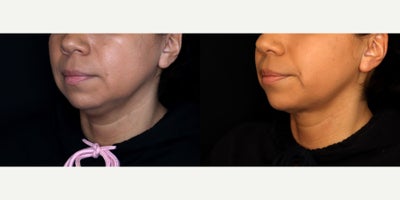 41 year old woman treated with Liposuction, PrecisionTx - 41 year old female treated with submental liposuction (Precision tx) Photos depict before and 6 months after surgery
