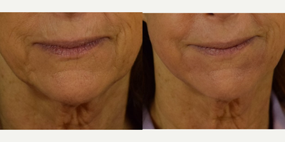 Before and after HALO Laser for Perioral Lines  - Notice the softening of lines and wrinkles and significant tightening achieved with one HALO&nbsp;laser treatment. &nbsp;