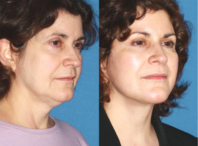 Signs of Age Reversed with a Facelift - Patient is concerned with the aging appearance of her face. Jowls, sagging cheeks and neck fat and skin laxity all contribute to the appearance of age. Facelift was performed.