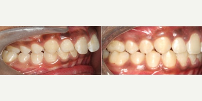 17 or under year old man treated with Damon Braces - Deep bite and class II malocclusion treated with Damon braces and class II elastics. 
Impressions orthodontics, Calgary.