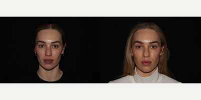 25-34 year old woman treated with Sofwave - Our guest came to us looking to help build collagen with Sofwave as a preventative measure to aging and has had great results at the 3 month mark. We are seeing a substantial lifted look in the hooding of her eyelids as well as softening of the nasal labial folds.