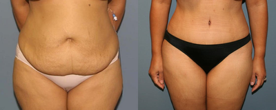tummy tuck - 	Young healthy postpartum mother with abdominal laxity after childbearing and weight loss.