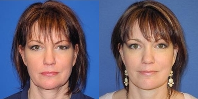 Neck Lift - This lovely patient was interested in improving her jawline and neckline as well as the appearance of her eyes. Dr. Salemy performed a lower face and neck lift and an upper eyelid tuck (blepharoplasty).