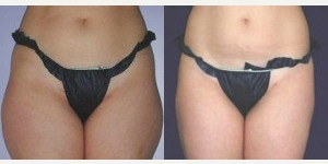 35-44 year old woman treated with UltraShape - 5cm reduction, Post 3 treatments.