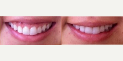18-24 year old woman treated with Lip Lowering - This patient's gummy smile was treated with upper lip lowering so the upper lip appears to be more full.