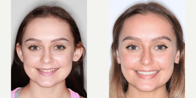 Teen Female Patient with Crowding - Age: 18 - 29Gender: FemaleProcedure: Clear Ceramic BracesThis teen female patient came to us with narrow upper and lower arches and moderate crowding. The dentist treated her with Clear Ceramic Braces for 13 months.