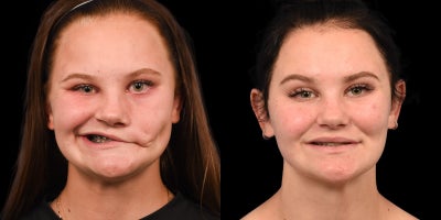 18-24 year old woman treated with Facial Reconstructive Surgery - Facial Reanimation Surgery Results  Natural Smile Restoration without Gracilis