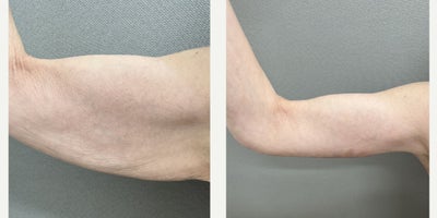 45-54 year old woman treated with Arm Lift - arm lift performed in our office operating room.