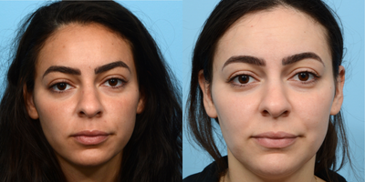 25-34 year old woman treated with Vbeam - This patient wanted to treat broken capillaries that she had on her face. These photos were taken before and after 3 sessions of VBeam with NP Radhika Patel.
