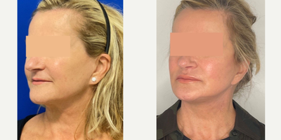 65-74 year old woman treated with Mini Facelift, Neck Lift - 66 year old woman treated with Mini Facelift, Neck Lift