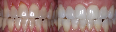Gum Lift - Patient treated with Gum Lift