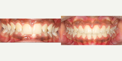 17 or under year old woman treated with Damon Braces - Teenager with deep bite and Class II malocclusion - small lower jaw. 
Damon braces for 16 months with elastic so to correct deep bite and full correction of class II.