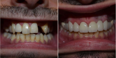 Man treated with Full Mouth Reconstruction - Dr. Ip used porcelain crowns as part of this patient's smile makeover.