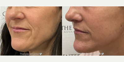 55-64 year old woman treated with Ellacor - Ellacor