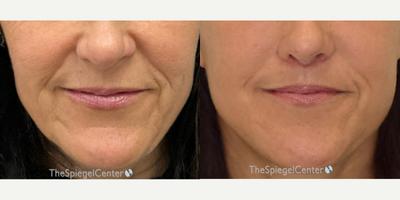 55-64 year old woman treated with Ellacor - Ellacor
