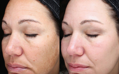 25-34 year old woman treated with Halo Laser - Halo Laser before and after