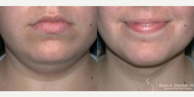Woman treated with Chin Liposuction - Woman treated with Chin Liposuction