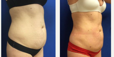 35-44 year old woman treated with Smart Lipo - Patient had liposuction performed