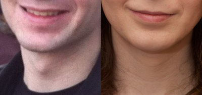 Adam's Apple Reduction - AKA Thyroid Cartilage Shave FFS