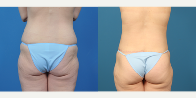 35-44 year old woman treated with Circumferential Tummy Tuck - 35-44 year old woman treated with Circumferential Tummy Tuck