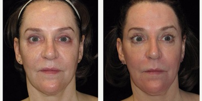 58 year old woman treated with Halo Laser - This 58 year-old was concerned with pigment spots, fine lines, and enlarged pores. She had previously done other laser treatments with mild improvement.She had a series of Halo Pro laser treatments and BBL treatments to diminish her pigment spots, reduce the redness in her face and improve the fine lines and pores.Her results are shown 3 months after her treatment series was completed.
Individual Results May Vary