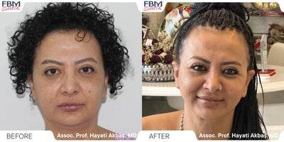45-54 year old woman treated with Deep Plane Facelift, Neck Lift, Eyelid Surgery - 45-54 year old woman treated with Deep Plane Facelift, Neck Lift, Eyelid Surgery