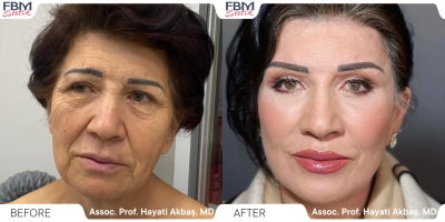 55-64 year old woman treated with Deep Plane Facelift, Eyelid Surgery, Double Eyelid Surgery, Lip Lift, Facial Fat Transfer - 55-64 year old woman treated with Deep Plane Facelift, Eyelid Surgery, Double Eyelid Surgery, Lip Lift, Facial Fat Transfer