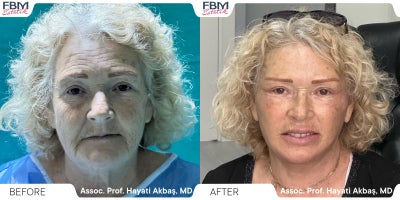 55-64 year old woman treated with Deep Plane Facelift, Neck Lift, Eyelid Surgery, Facial Fat Transfer - 55-64 year old woman treated with Deep Plane Facelift, Neck Lift, Eyelid Surgery, Facial Fat Transfer