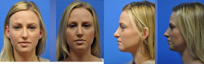 Revision rhionplasty - This women had a prior rhinoplasty with significant deformities of the tip and nostrils.  She desired improvements.  She underwent revision surgery with focus on correcting prior damage to the lower lateral cartilages.  Rib cartilage grafts were used to  rebuild these important structures that are important for nasal shape and function.  The post op photos are from a relatively close follow up time, thus edema (swelling) is still present.  Nonetheless, the progress made in surgery is evident in the tip, nostrils, and elsewhere.