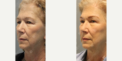 Woman treated with Eyelid Surgery - My patient - pictured here - is a perfect example of the subtle results of the impactful transformation a brow lift paired with eyelid surgery can make in reducing the signs of aging. Unfortunately, as we all rely so much on our eyes and eyebrows to express emotions, the delicate skin in these areas can begin to wrinkle and sag sooner than your other facial features, which is what this patient had concerns about. She wanted to conservatively raise her eyebrows to ensure a natural result; look at how the outer portion of her eyebrow is raised in the AFTER photo and as a result, we can see more of her upper eyelid For patients wanting a refreshed look, a brow lift or upper/lower eyelid lift may be procedures to consider, as they remove excess and drooping skin, leading to a more alert and youthful appearance.