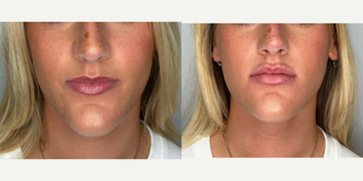 18-24 year old woman treated with Nonsurgical Nose Job, Lip Fillers, Revanesse - patient treated with revanesse versa for liquid rhinoplasty and lip augmentation