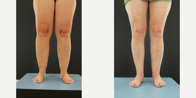 45-54 year old woman treated with Lipedema Surgery - This lovely woman suffers from a condition called Lipedema, which affects mostly the lower calf and ankle area depending on the stage that she is in. There are three stages and each one is more extreme, other procedures include but are not limited to Arm Augmentation through either Liposuction or a skin excision depending on the skins laxity. as well as Thigh Lifts.