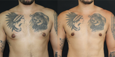 25-34 year old man treated with Breast Reduction - Gynecomastia