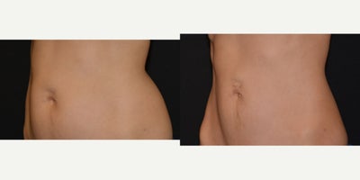 35-44 year old woman treated with Evolve - Patient finished series of body sculpting with Evolve Transform. Treated by Alyssa G.