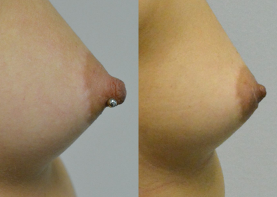25-34 year old woman treated with Nipple Reduction Surgery - A woman in her 30s who is bothered by prominence of her nipples. She is shown before and again, 4 months after Top hat flap nipple papule reduction that reduces the diameter and the height of the nipple. She is thrilled to have a normal appearance to her nipples and no longer is self-conscious with the prominence of her nipples in clothing.