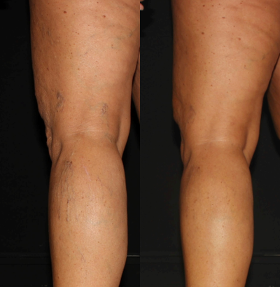 35-44 year old woman treated with Asclera - Results after one session of Asclera to spider veins on legs.