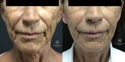 55-64 year old woman treated with Vivace - Patient was looking to reverse some signs of aging from years of sun damage. After photo was taken 1 month after 3rd treatment of Vivace RF Microneedling + PRP. Patient also received 1st treatment of Sculptra to upper lip, cheek bones and pre jowl 1 month prior to After Photo.